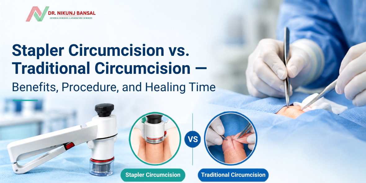 Stapler Circumcision vs. Traditional Circumcision — Benefits, Procedure, and Healing Time